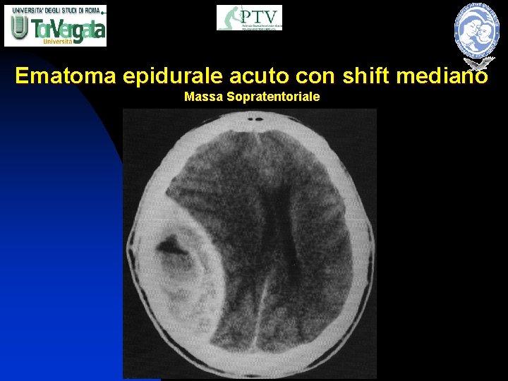 Ematoma epidurale acuto con shift mediano Massa Sopratentoriale 