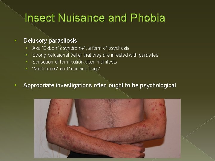 Insect Nuisance and Phobia • Delusory parasitosis • • • Aka “Ekbom’s syndrome”, a