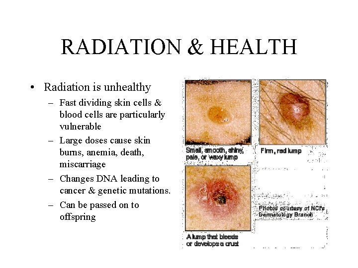 RADIATION & HEALTH • Radiation is unhealthy – Fast dividing skin cells & blood RADIATION & HEALTH • Radiation is unhealthy – Fast dividing skin cells & blood