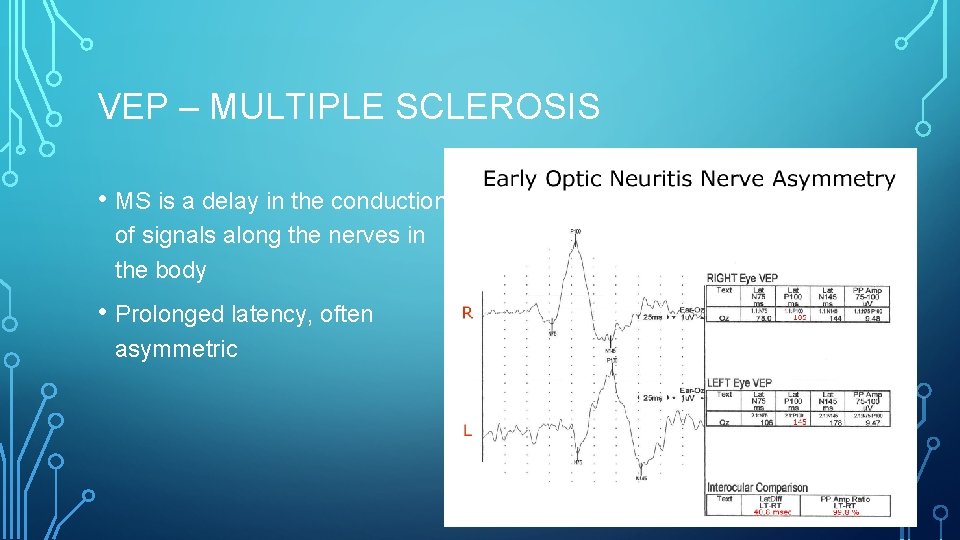 VEP – MULTIPLE SCLEROSIS • MS is a delay in the conduction of signals