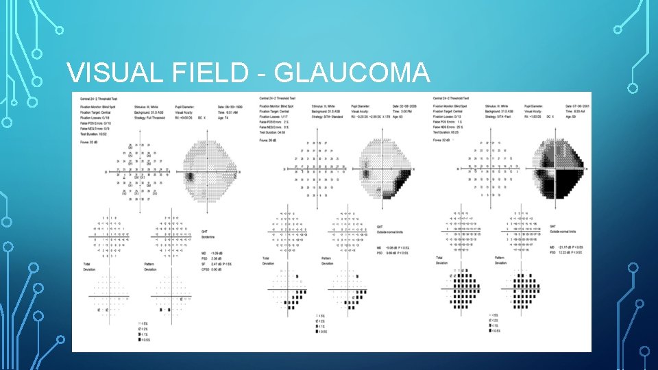 VISUAL FIELD - GLAUCOMA 