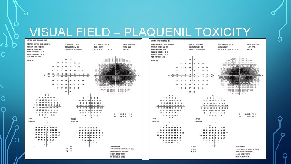 VISUAL FIELD – PLAQUENIL TOXICITY 