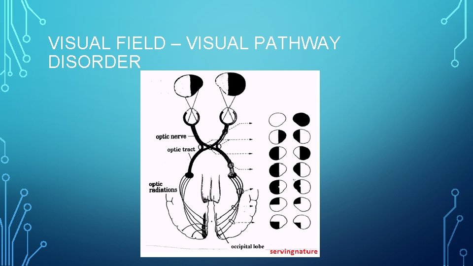 VISUAL FIELD – VISUAL PATHWAY DISORDER 