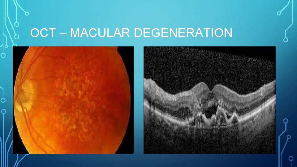 OCT – MACULAR DEGENERATION 