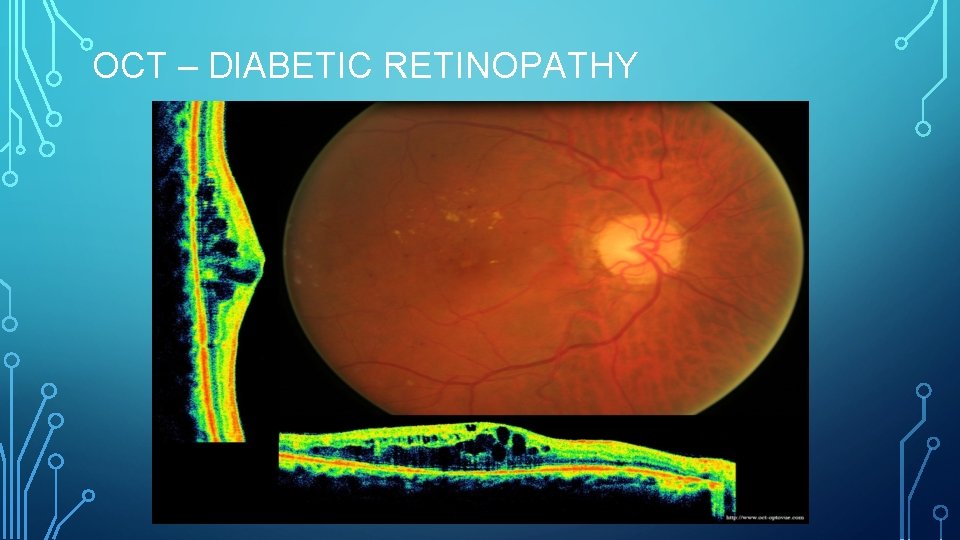 OCT – DIABETIC RETINOPATHY 