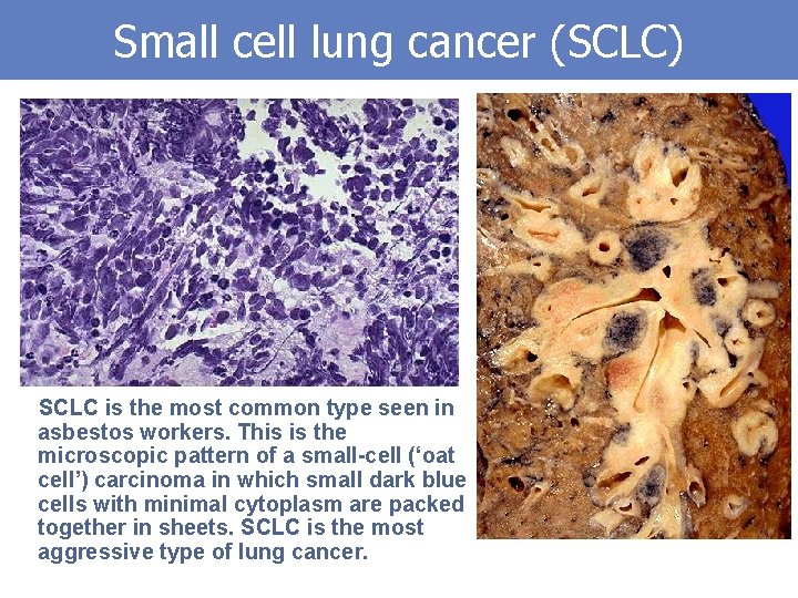 Small cell lung cancer (SCLC) SCLC is the most common type seen in asbestos