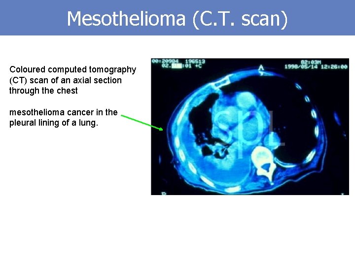 Mesothelioma (C. T. scan) Coloured computed tomography (CT) scan of an axial section through