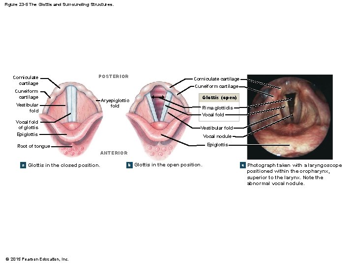 Figure 23 -5 The Glottis and Surrounding Structures. Corniculate cartilage POSTERIOR Corniculate cartilage Cuneiform