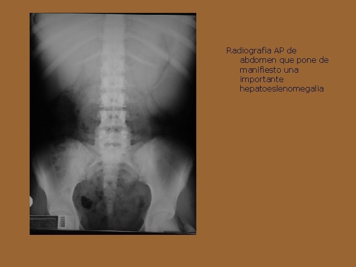Radiografía AP de abdomen que pone de manifiesto una importante hepatoeslenomegalia 