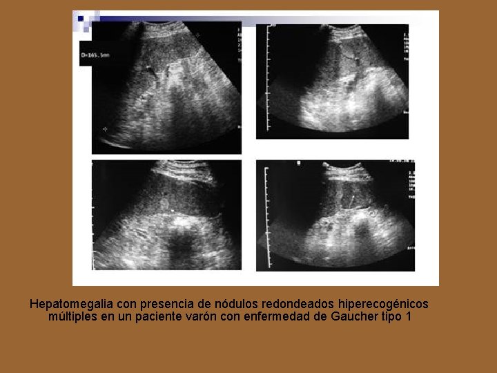 Hepatomegalia con presencia de nódulos redondeados hiperecogénicos múltiples en un paciente varón con enfermedad