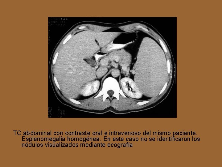 TC abdominal contraste oral e intravenoso del mismo paciente. Esplenomegalia homogénea. En este caso