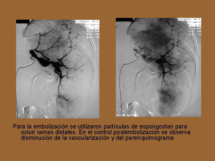 Para la embolización se utilizaron partículas de espongostan para ocluir ramas distales. En el