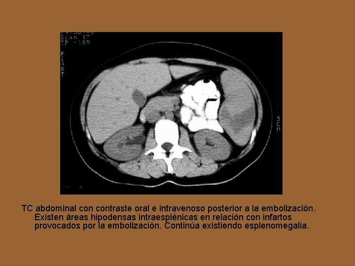 TC abdominal contraste oral e intravenoso posterior a la embolización. Existen áreas hipodensas intraesplénicas