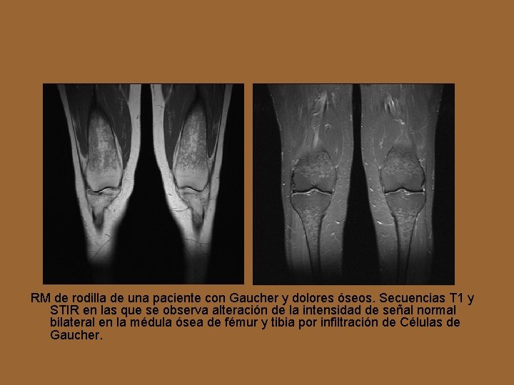 RM de rodilla de una paciente con Gaucher y dolores óseos. Secuencias T 1