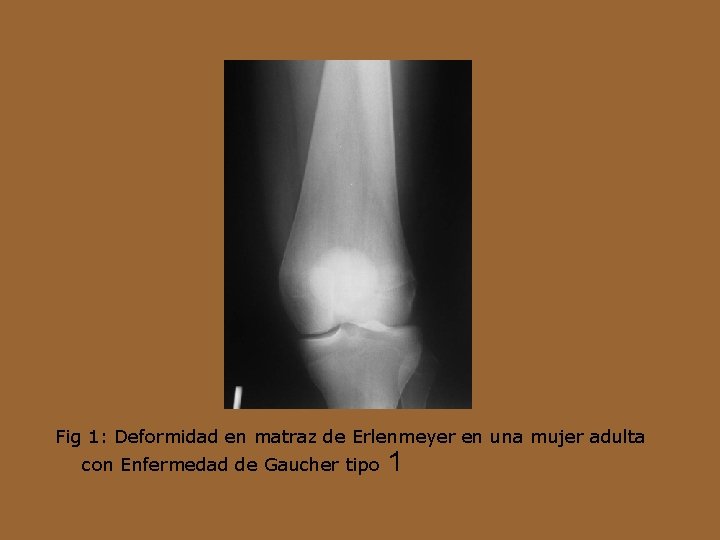 Fig 1: Deformidad en matraz de Erlenmeyer en una mujer adulta con Enfermedad de