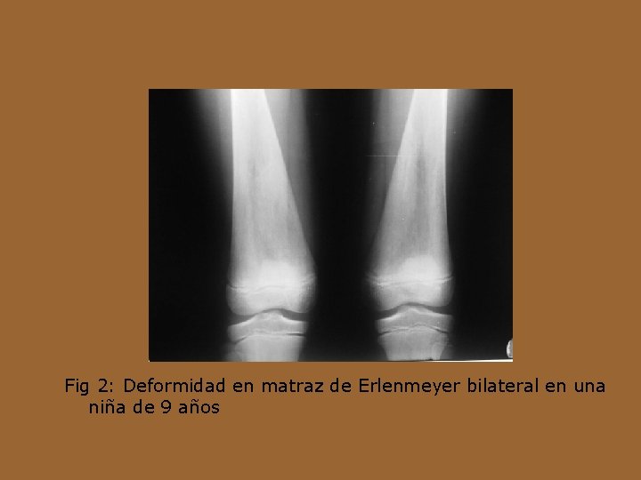 Fig 2: Deformidad en matraz de Erlenmeyer bilateral en una niña de 9 años