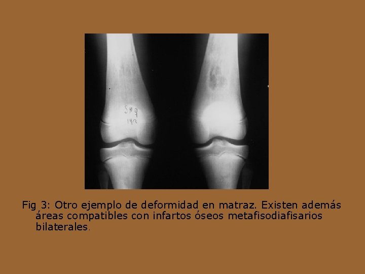 Fig 3: Otro ejemplo de deformidad en matraz. Existen además áreas compatibles con infartos