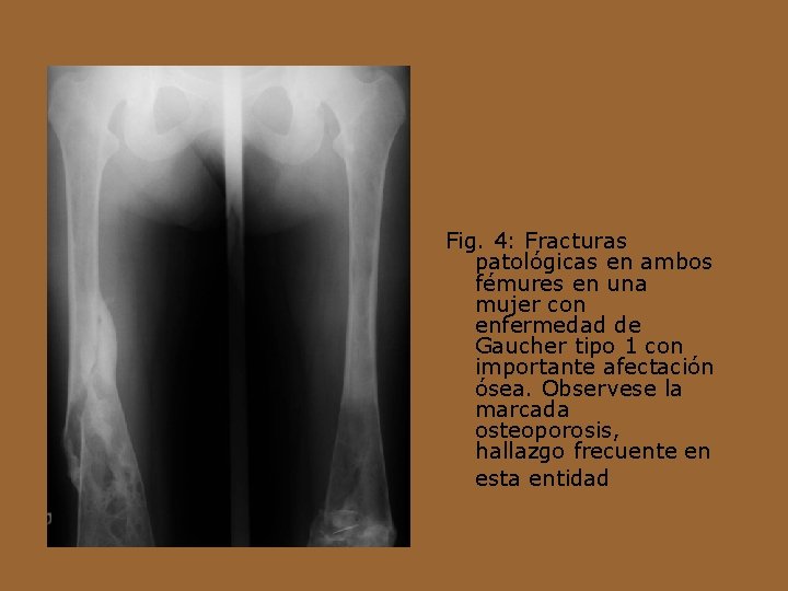 Fig. 4: Fracturas patológicas en ambos fémures en una mujer con enfermedad de Gaucher