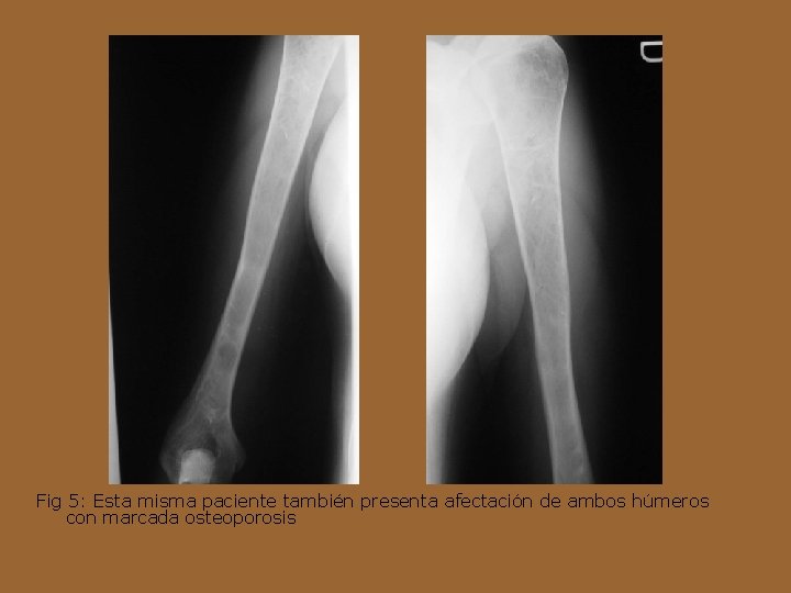 Fig 5: Esta misma paciente también presenta afectación de ambos húmeros con marcada osteoporosis