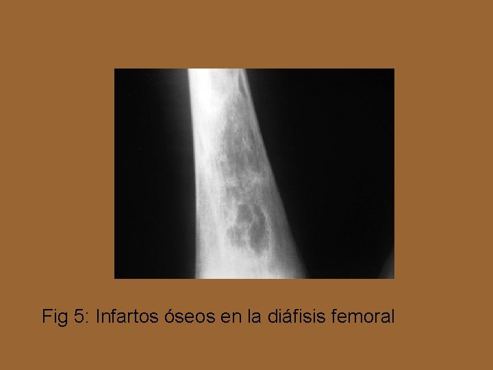 Fig 5: Infartos óseos en la diáfisis femoral 