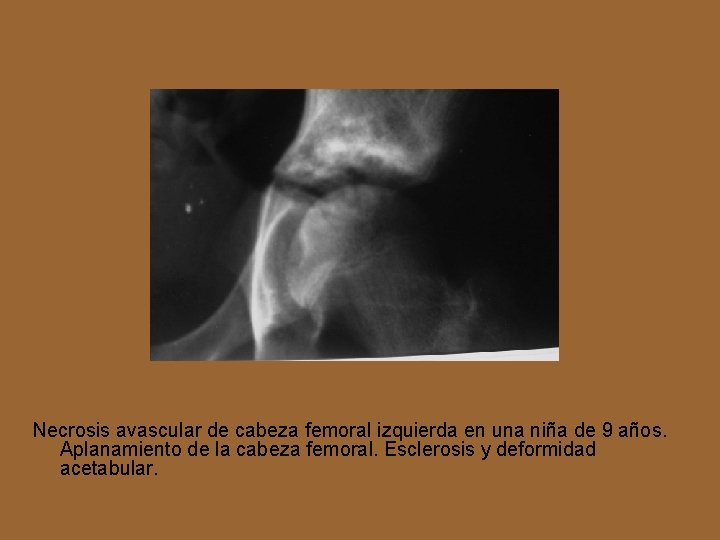 Necrosis avascular de cabeza femoral izquierda en una niña de 9 años. Aplanamiento de