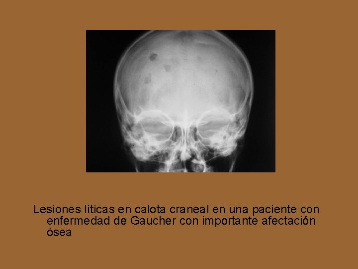 Lesiones líticas en calota craneal en una paciente con enfermedad de Gaucher con importante