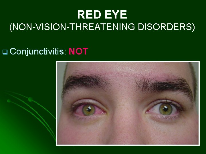 RED EYE (NON-VISION-THREATENING DISORDERS) q Conjunctivitis: NOT 