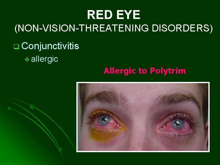 RED EYE (NON-VISION-THREATENING DISORDERS) q Conjunctivitis v allergic Allergic to Polytrim 