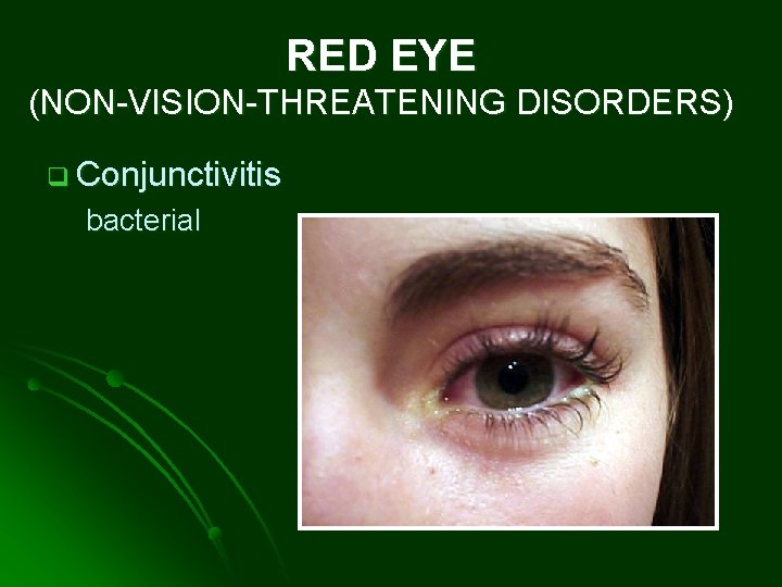 RED EYE (NON-VISION-THREATENING DISORDERS) q Conjunctivitis bacterial 