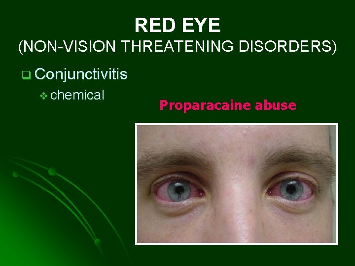 RED EYE (NON-VISION THREATENING DISORDERS) q Conjunctivitis v chemical Proparacaine abuse 