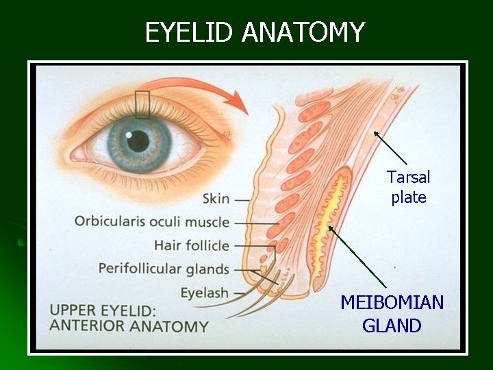 EYELID ANATOMY Tarsal plate MEIBOMIAN GLAND 