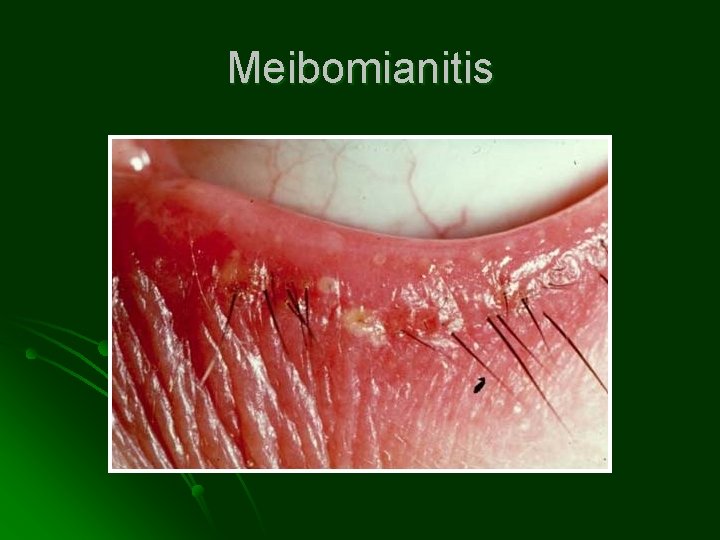 Meibomianitis 