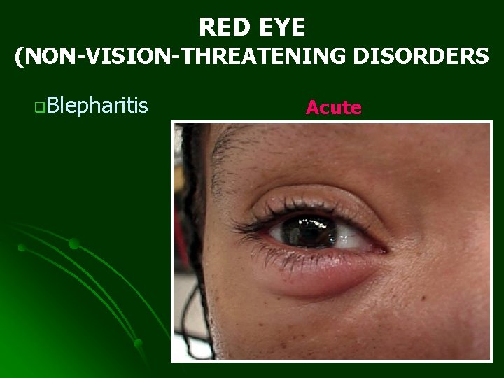 RED EYE (NON-VISION-THREATENING DISORDERS q. Blepharitis Acute 