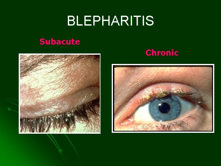 BLEPHARITIS Subacute Chronic 