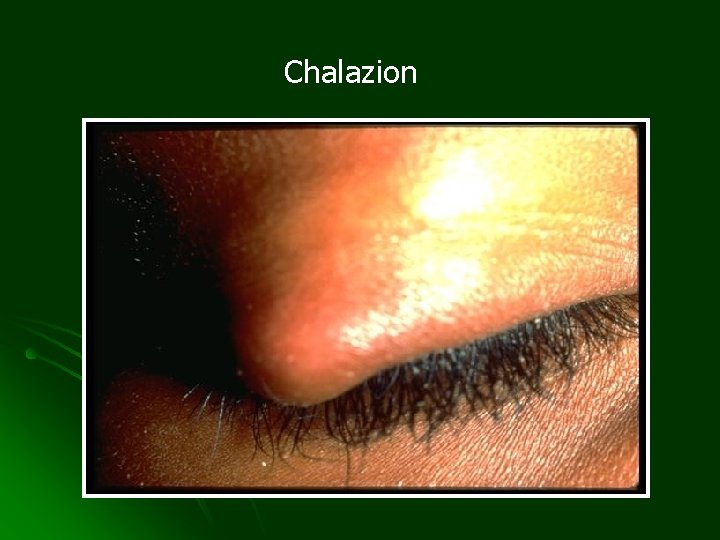 Chalazion 