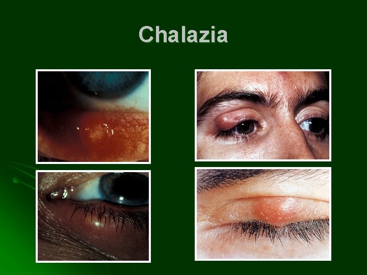 Chalazia 