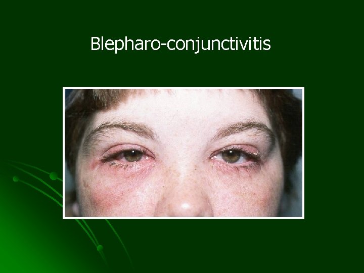 Blepharo-conjunctivitis 