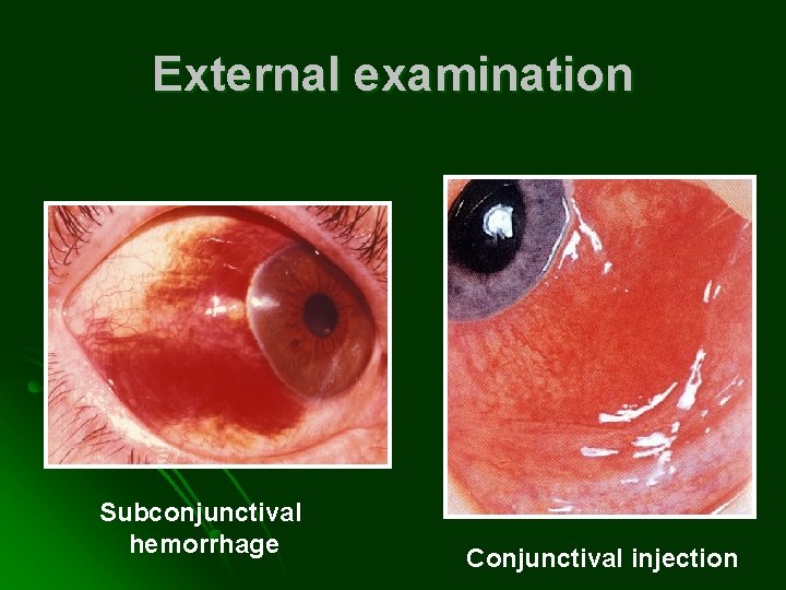 External examination Subconjunctival hemorrhage Conjunctival injection 