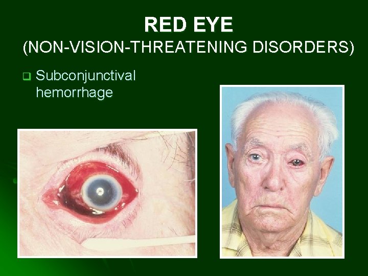 RED EYE (NON-VISION-THREATENING DISORDERS) q Subconjunctival hemorrhage 