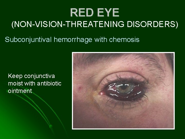 RED EYE (NON-VISION-THREATENING DISORDERS) Subconjuntival hemorrhage with chemosis Keep conjunctiva moist with antibiotic ointment