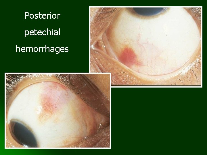 Posterior petechial hemorrhages 