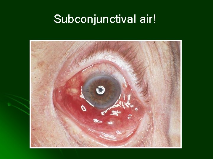 Subconjunctival air! 