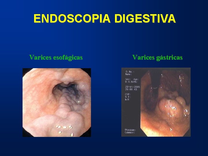 ENDOSCOPIA DIGESTIVA Varices esofágicas Varices gástricas 