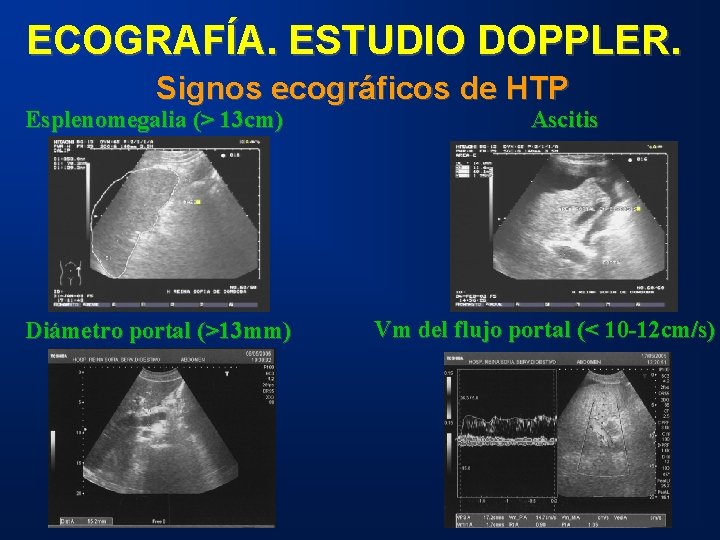 ECOGRAFÍA. ESTUDIO DOPPLER. Signos ecográficos de HTP Esplenomegalia (> 13 cm) Diámetro portal (>13