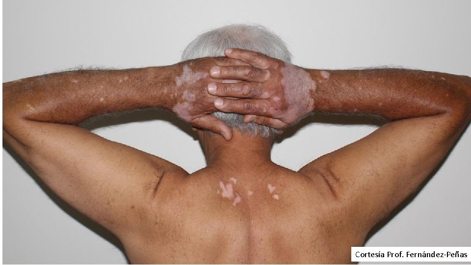 Cortesía Prof. Fernández-Peñas 