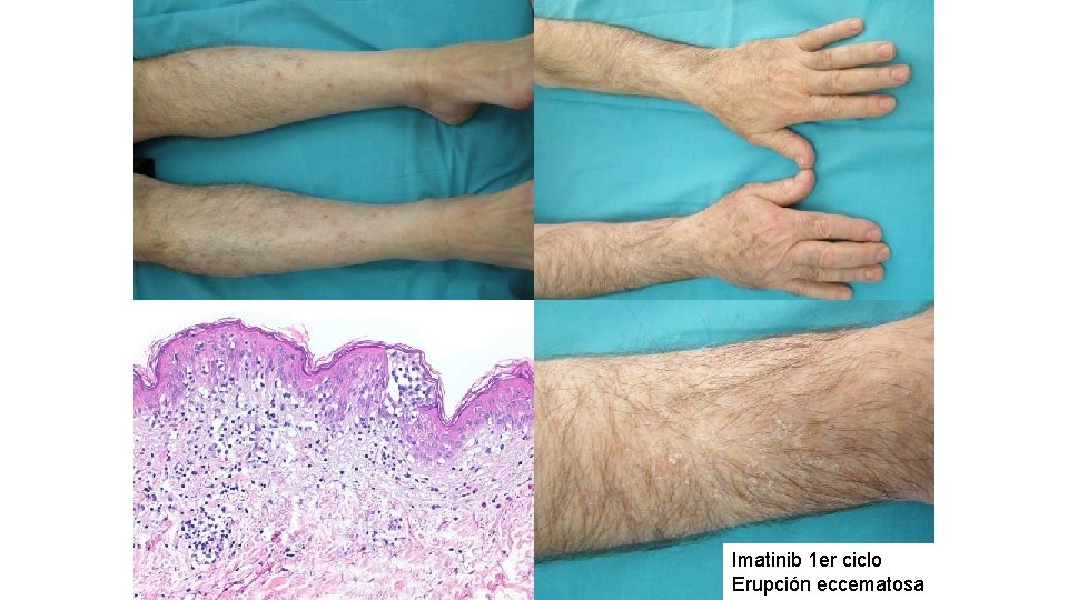 Imatinib 1 er ciclo Erupción eccematosa 