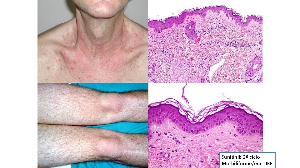 Sunitinib 2º ciclo Morbiliforme/em-LIKE 