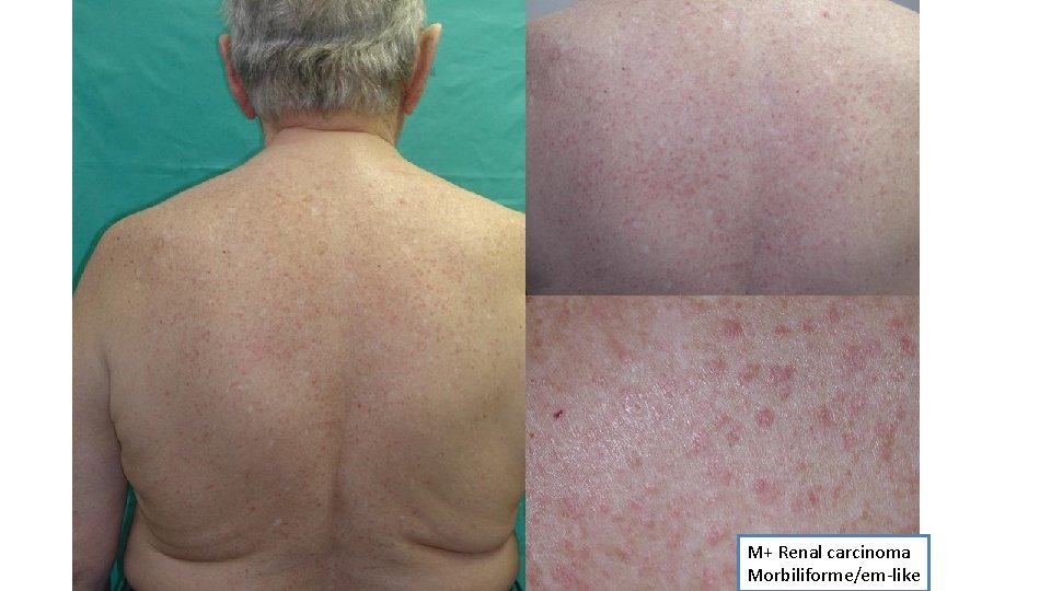 M+ Renal carcinoma Morbiliforme/em-like 