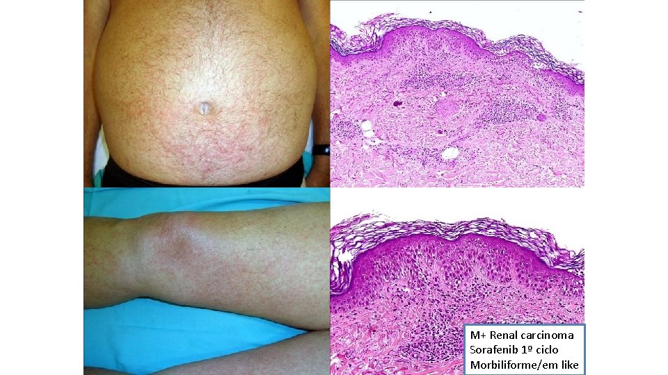 M+ Renal carcinoma Sorafenib 1º ciclo Morbiliforme/em like 