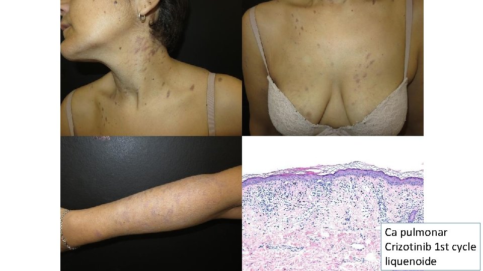 Ca pulmonar Crizotinib 1 st cycle liquenoide 